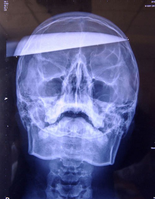 CS Wall Hack Nearly Costs Chinese Gamer His Life